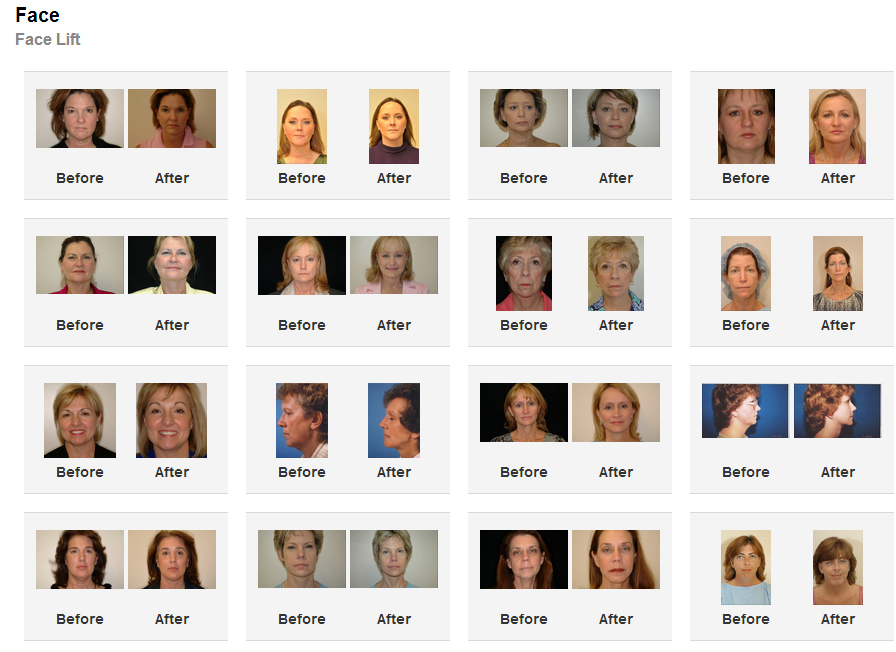 facelift surgery before and after photos